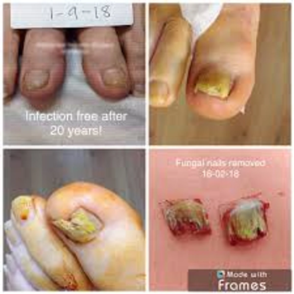 Fungal Removal Nail Treatment