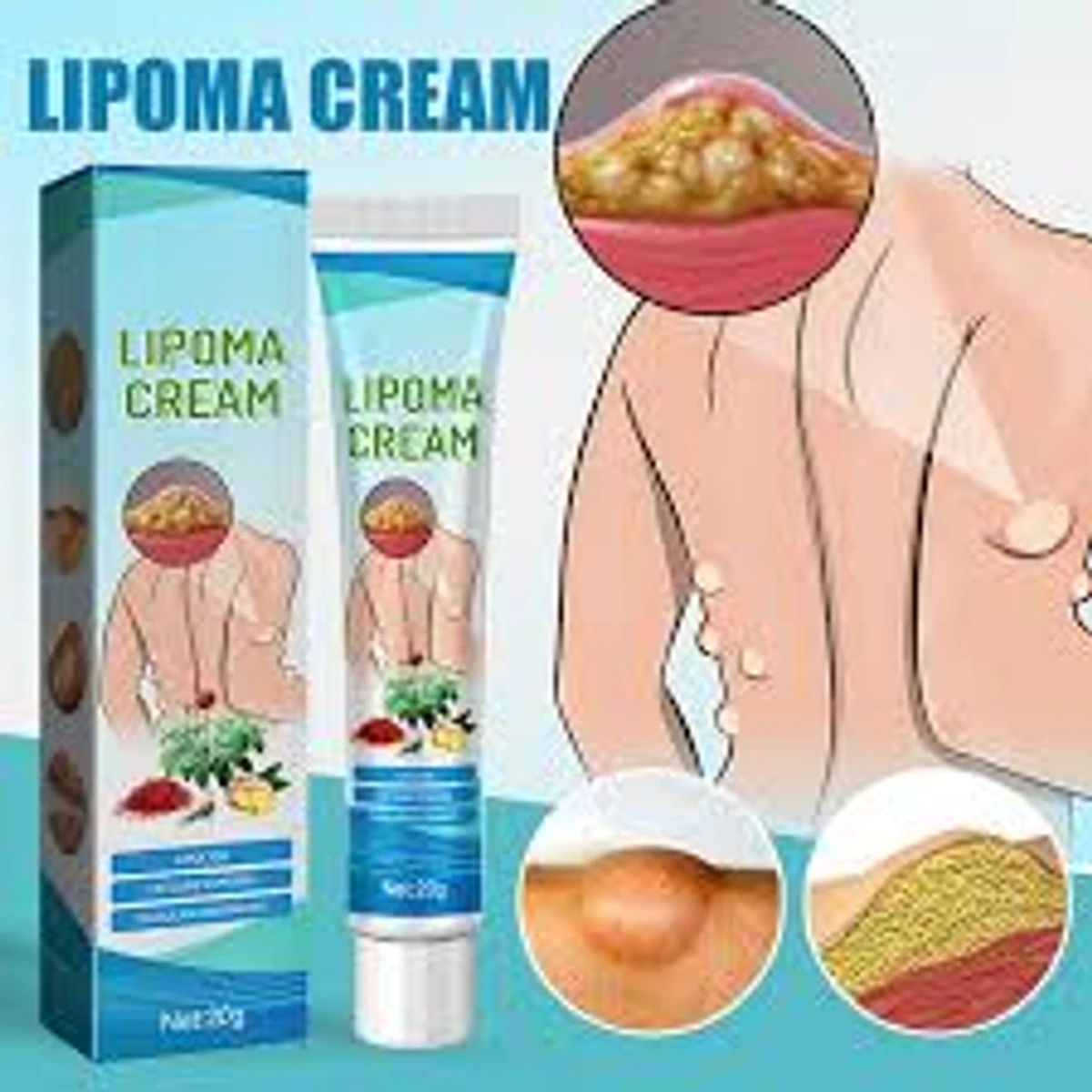 Lipoma Removal Cream Treatment Relieve