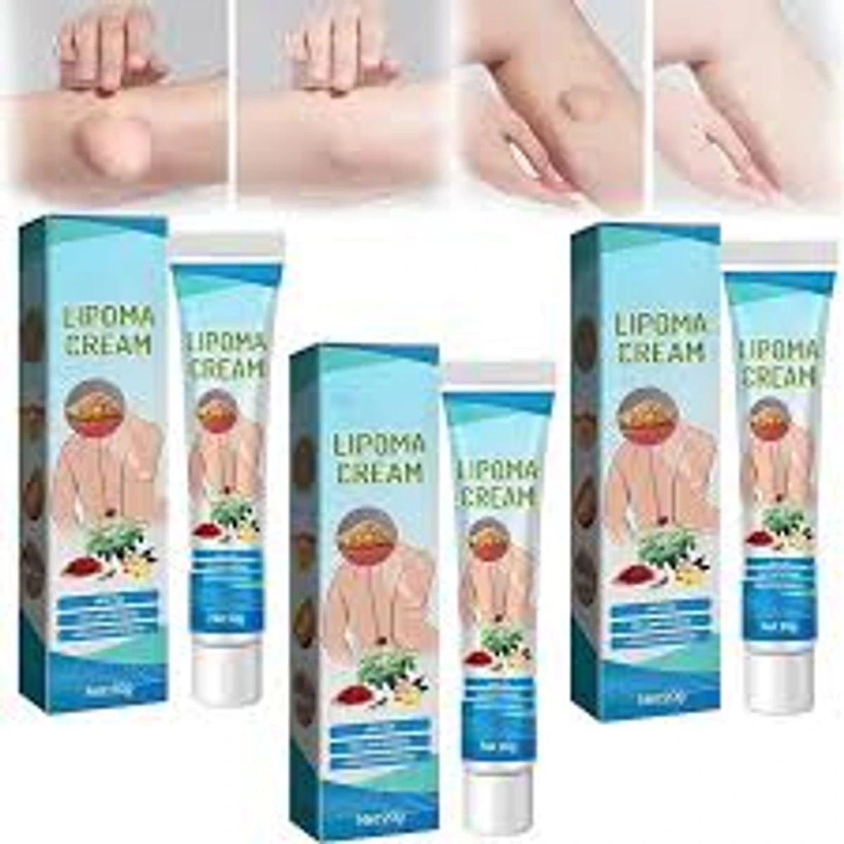 Lipoma Removal Cream Treatment Relieve